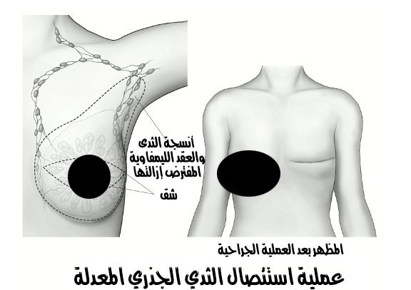  استئصال الثدي الجذري