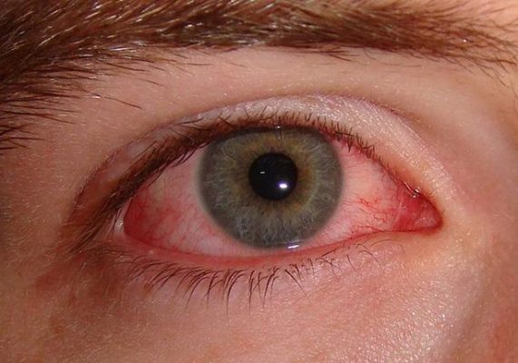 قطرة أبيكورت فورت لحساسية والتهابات العين